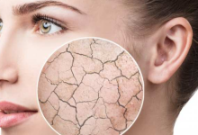 Photo of Skin Dryness: रूखी त्वचा से छुटकारा चाहते हैं तो अपनाएं ये आसान नुस्खे