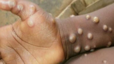 Photo of Monkeypox को लेकर अलर्ट, सरकार ने जारी की SOP, अस्पतालों रिजर्व किये जायेंगे बेड